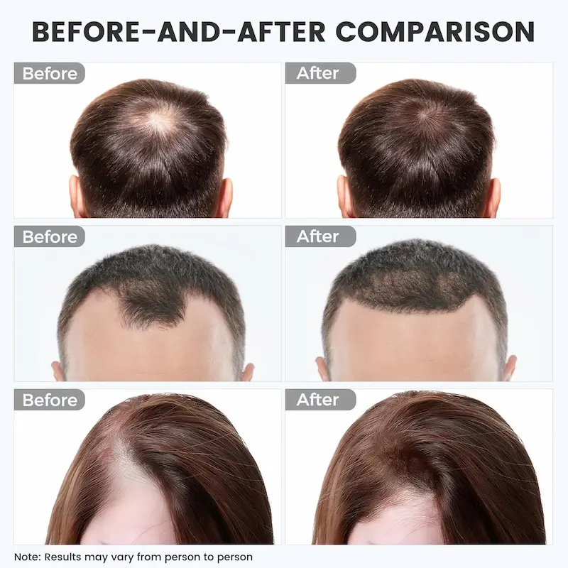 Before and After Hair Appearance with Laser Hair Growth Cap